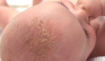 Baby with cradle cap