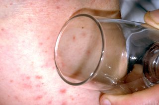 Meningitis glass test