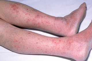 Meningitis rash