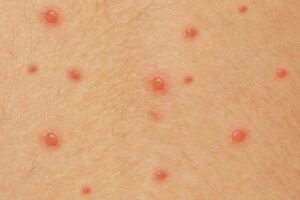 White skin with stage 2 chickenpox spots.

There are 13 spots that vary in size, but they're all less than 1cm. Some spots are close to others. Almost all the spots have formed a round or slightly oval blister. 1 spot looks flatter.

The blisters are pink and shiny. The skin around some spots looks slightly pink.