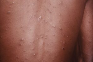 Dark-brown skin with stage 2 chickenpox spots and blisters. There are about 50 spots on a person's back and arm.

The spots vary in size from around 5mm to 1cm. Some are close to others. Many of the spots have formed a round or slightly oval shaped raised blister.

Some of the blisters look like they have burst and some may be forming a scab. Most blisters are the same colour or slightly darker than the person's skin. Some blisters look shiny and slightly white or grey.
