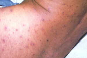 Medium-brown skin with stage 3 chickenpox spots. The spots cover the lower part of a person's back and the side of their hip.

There are about 50 spots in total, varying in size from about 1mm to 1cm. Some are 1cm to 3cm apart, but others are further apart.

Most of the spots have scabs over them. The scabs are pink, purple or grey. There are also a few spots without scabs, which look like small blisters. These are slightly darker in colour than the person's skin.