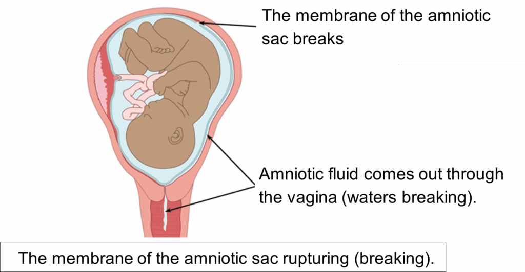 Imagine showing the membrane of the amniotic sac reputuring (breaking)