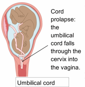 Image showing cord prolapse due to PPROM