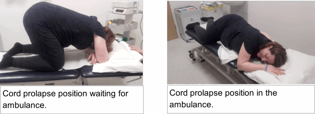Image showing woman in positions required in the event of a cord prolapse