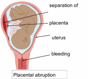 Graphic showing what happens in a placental abruption